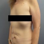 Abdominoplasty Before & After Patient #2138