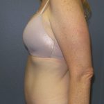 Abdominoplasty Before & After Patient #2138