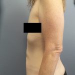 Abdominoplasty Before & After Patient #2138