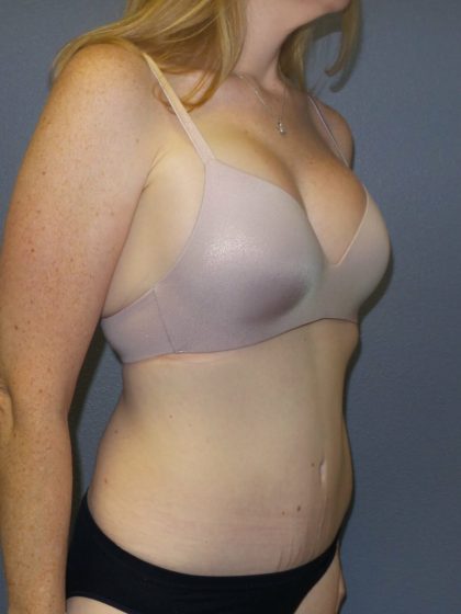Abdominoplasty Before & After Patient #2138