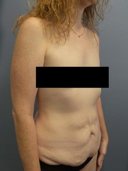 Abdominoplasty Before & After Patient #2138