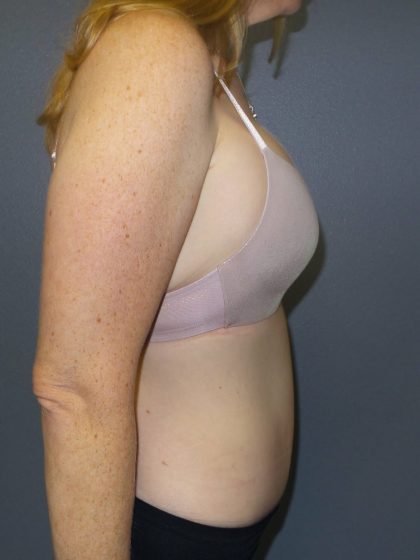 Abdominoplasty Before & After Patient #2138