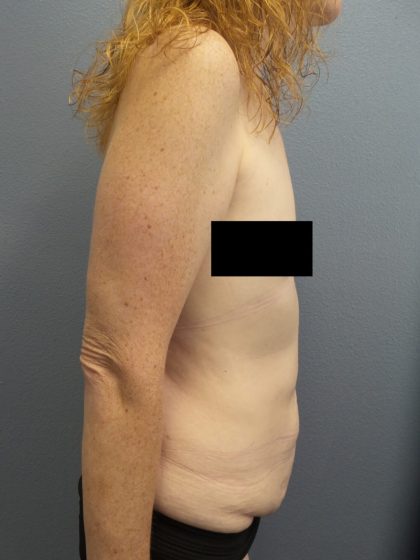 Abdominoplasty Before & After Patient #2138
