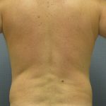 Male Liposuction Before & After Patient #1881
