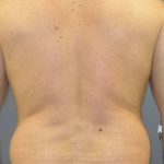 Male Liposuction Before & After Patient #1881