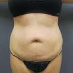 Liposuction Female Before & After Patient #1198
