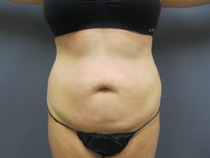 Liposuction Female Before & After Patient #1198