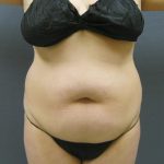 Liposuction Female Before & After Patient #1198