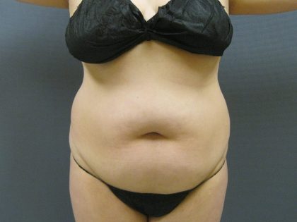 Liposuction Female Before & After Patient #1198