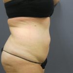 Liposuction Female Before & After Patient #1198