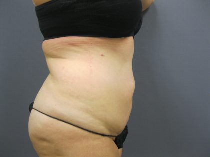 Liposuction Female Before & After Patient #1198