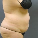 Liposuction Female Before & After Patient #1198