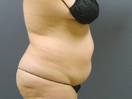 Liposuction Female Before & After Patient #1198