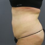 Liposuction Female Before & After Patient #1198