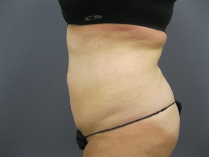 Liposuction Female Before & After Patient #1198