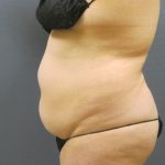 Liposuction Female Before & After Patient #1198
