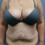 Abdominoplasty Before & After Patient #2170
