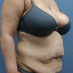Abdominoplasty Before & After Patient #2170