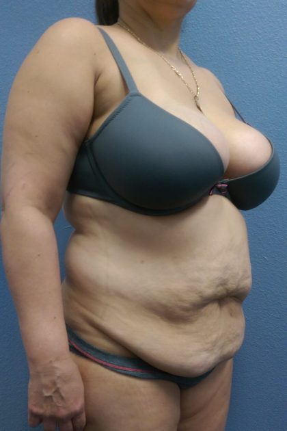 Abdominoplasty Before & After Patient #2170