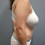 Abdominoplasty Before & After Patient #2170