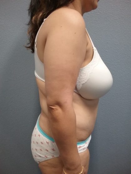 Abdominoplasty Before & After Patient #2170