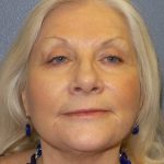 Facelift Before & After Patient #949