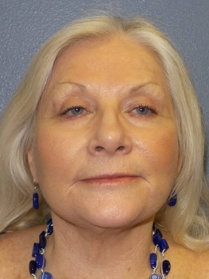 Facelift Before & After Patient #949