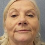 Facelift Before & After Patient #949