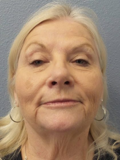 Facelift Before & After Patient #949