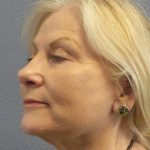 Facelift Before & After Patient #949