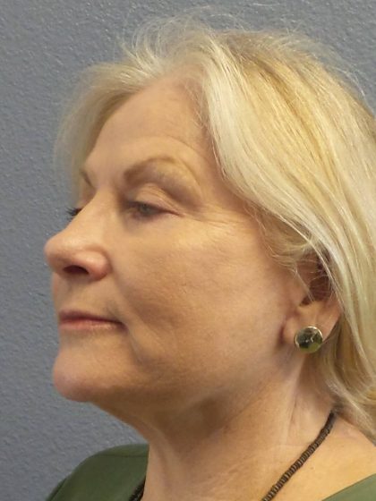 Facelift Before & After Patient #949