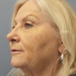 Facelift Before & After Patient #949