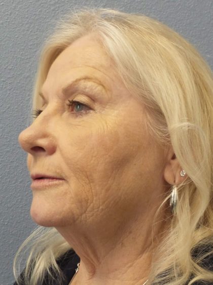 Facelift Before & After Patient #949