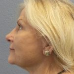 Facelift Before & After Patient #949