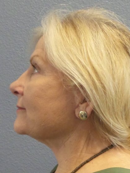 Facelift Before & After Patient #949