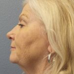Facelift Before & After Patient #949