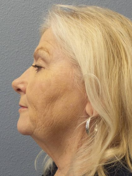 Facelift Before & After Patient #949