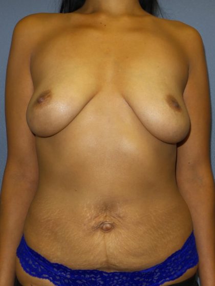 Mommy Makeover Before & After Patient #1953