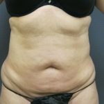 Liposuction Female Before & After Patient #1101