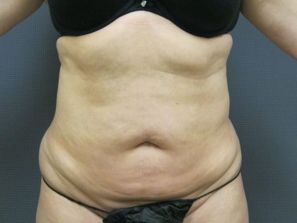 Liposuction Female Before & After Patient #1101