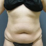 Liposuction Female Before & After Patient #1101
