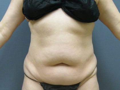 Liposuction Female Before & After Patient #1101