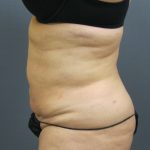 Liposuction Female Before & After Patient #1101