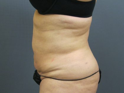 Liposuction Female Before & After Patient #1101