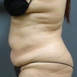 Liposuction Female Before & After Patient #1101