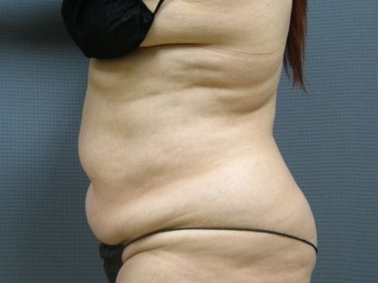Liposuction Female Before & After Patient #1101