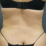 Liposuction Female Before & After Patient #1101