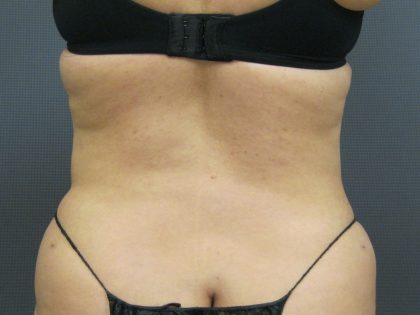 Liposuction Female Before & After Patient #1101