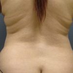 Liposuction Female Before & After Patient #1101