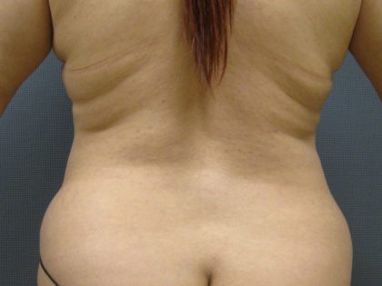 Liposuction Female Before & After Patient #1101